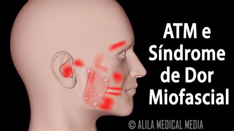 Anima O Explicativa Sobre Atm E S Ndrome De Dor Miofascial Alila