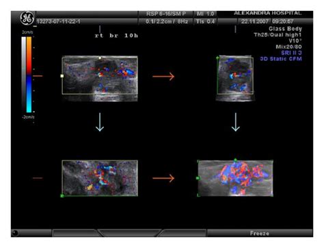 3d Power Doppler Imaging Of A Malignant Tumor With Chaotic Vessels