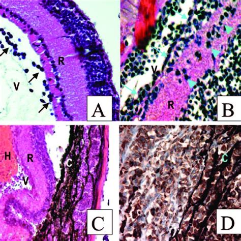 Histopathology Of Intracranial B Cell Lymphoma After Intracranial