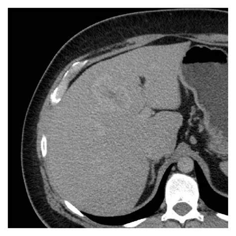 Abdominal Contrast Enhanced Ct A And B Scans On Arterial And Download Scientific Diagram