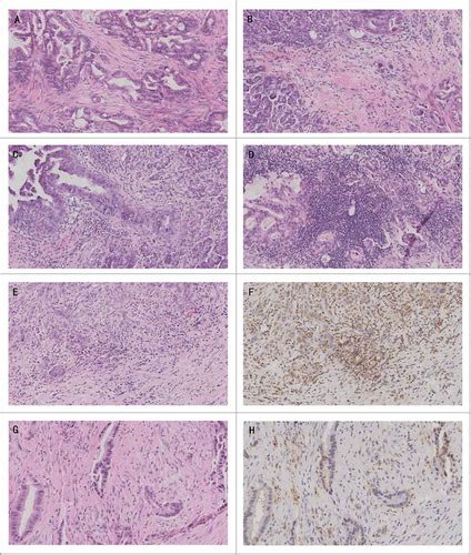 Full Article The Predictive Value And Role Of Stromal Tumor Infiltrating Lymphocytes In