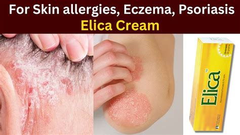 Elica Cream How To Use Elica Cream For Eczema Medicine For Skin