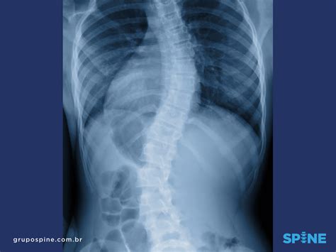 Grupo Spine Conhe A A Escoliose Idiop Tica E Como Ela Afeta Sua Vida