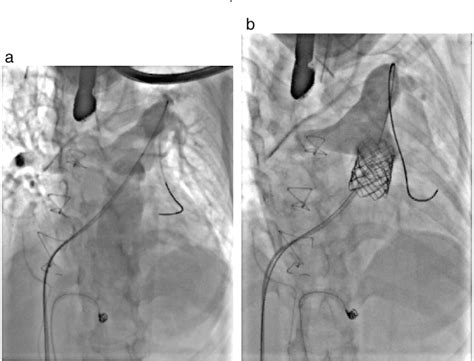 glenn shunt semantic scholar