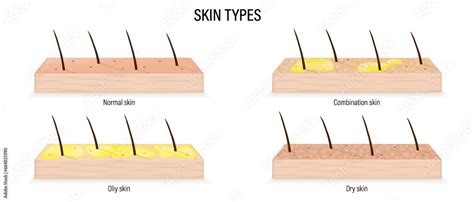 Skin types vector. Different types of skin problems. Normal ...