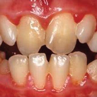 A Intraoral View Of Central Incisors B Panoramic Radiograph C