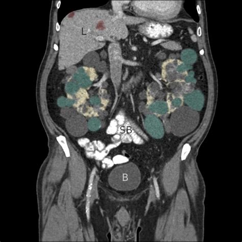 Medullary Sponge Kidney Paintbrush