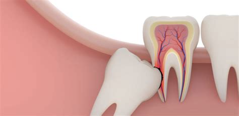 Wisdom Teeth Guide Everything You Need To Know About Your Last Molars Burwood Dental Care