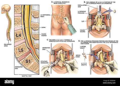 Lumbar Laminectomy Hi Res Stock Photography And Images Alamy