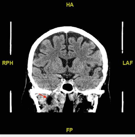 Ct Scan Demonstrating The Lesion At The Time Of Presentation Ct