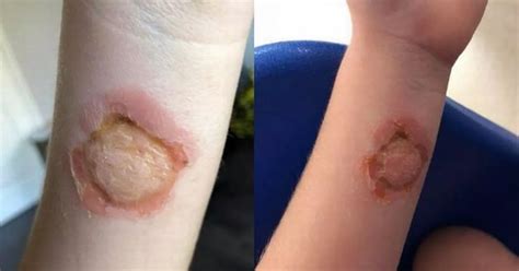 Mum S False Widow Spider Warning After Daughter Suffers Horror Bite