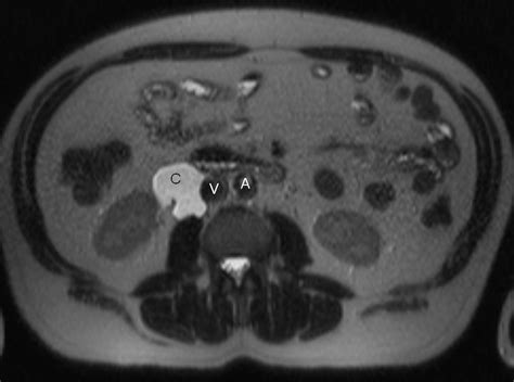 Infected Retroperitoneal Cystic Lymphangioma A Case Report Eurorad