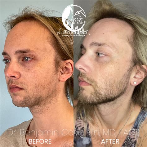 Combination Of Buccal Fat Removal Jawline Sculpting Chin Implant