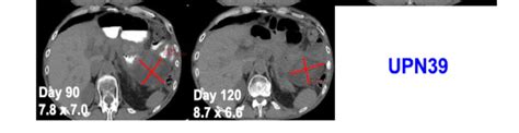 Computed Tomography Scans Of A Patient With Metastatic Treatment