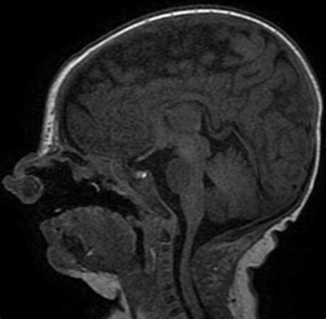 Radiology Of Cleft Lip And Palate Imaging For The Prenatal Period And