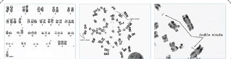 G Banded Karyotype Of Bone Marrow Cells Representative G Banded Download Scientific Diagram