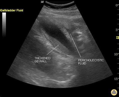 Chronic Cholecystitis Ultrasound Wes Sign