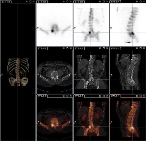 Pain Management And Nuclear Medicine Spectct Imaging Citiscan