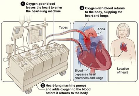 Heart Surgery Types Open Bypass Ablation Heart Valve Surgery