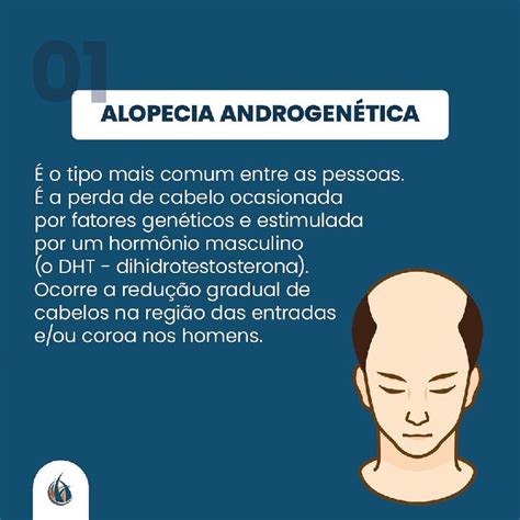 Tratamento alopecia androgenética masculina Doutor Alberto Correia