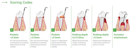 Базовое пародонтальное обследование Basic Periodontal Examination