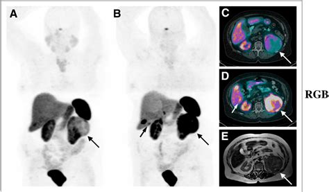 PDF Comparison Of 68Ga DOTANOC And 68Ga DOTATATE PET CT Within