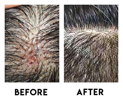 Scalp Acne Removal Treatment Singapore | Try for $28