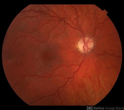 Pseudo Foster Kennedy Syndrome Retina Image Bank