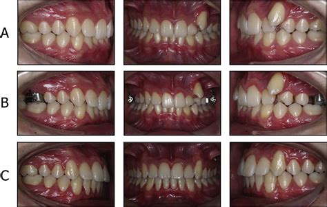 Effects Of Zygoma Gear Appliance For Unilateral Maxillary Molar