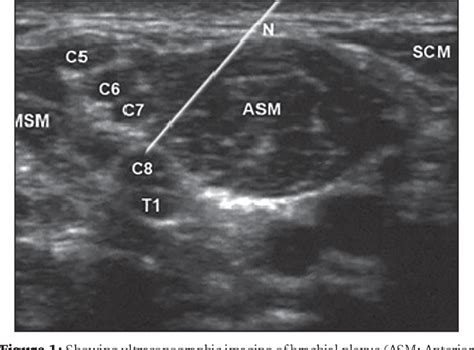 Figure 1 From Clonidine As An Adjuvant For Ultrasound Guided