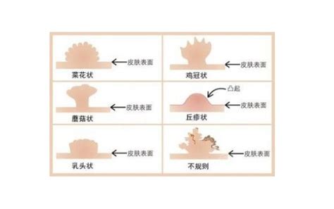 尖銳濕疣初期症狀圖片有哪些？正常人顆粒多久不長大排除尖銳 壹讀