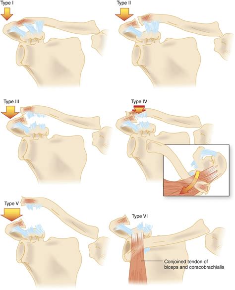 Acromioclavicular Injuries Wikem