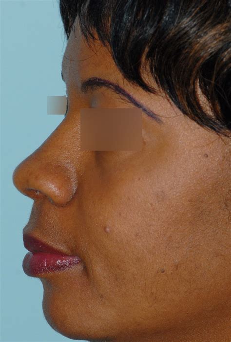 Photos De Rhinoplastie Avec Pointe Du Nez Trop Large Avant Et Apr S