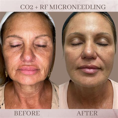 Co2 Resurfacing Eluma Laser And Aesthetics