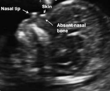 A Midsagittal Section Of A Week Fetus Demonstrating An Absent Nasal