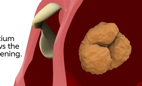 Aortic Stenosis Overview American Heart Association Cpr And First Aid