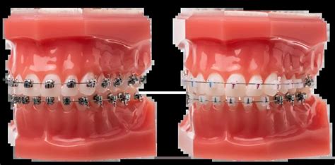 Appareils Multi Attaches Orthodontie Du Dr Ohayon Strasbourg