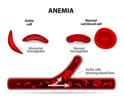 Treatment of sickle cell disease « Oladstudy