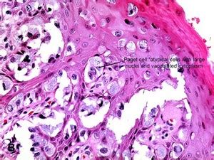 Paget S Disease Histology