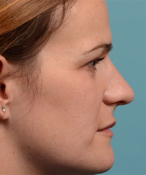 Toronto Rhinoplasty Dr Oakley Smith Before And After 373