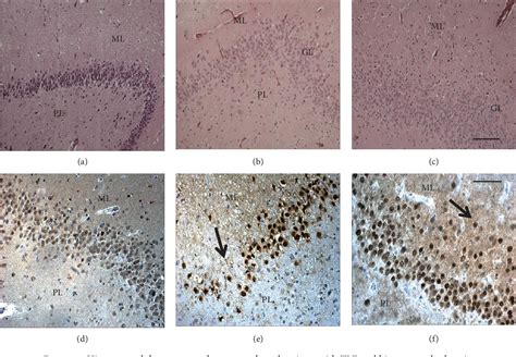 Figure From Depression And Temporal Lobe Epilepsy Expression Pattern