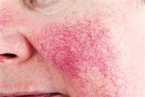 Rosacea Christchurch Medical Practice