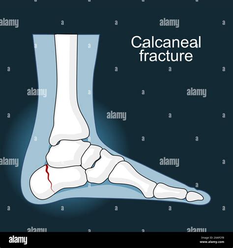 Calcaneal Fracture Trauma Of Heel Bone Foot Injury Anatomy Of Foot