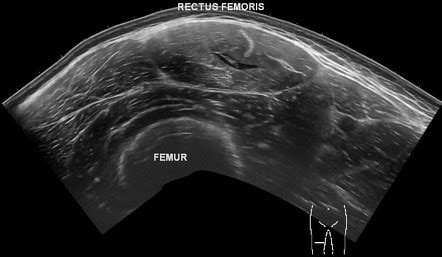 Rectus Femoris Tear Ultrasound