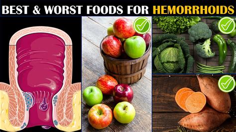 Hemorrhoids Best And Worst Foods For Hemorrhoids What To Eat And What To Avoid If You Have