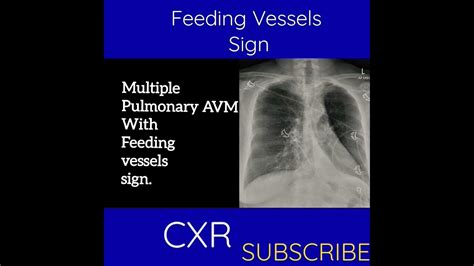 Cxr Feeding Vessels Sign Youtube