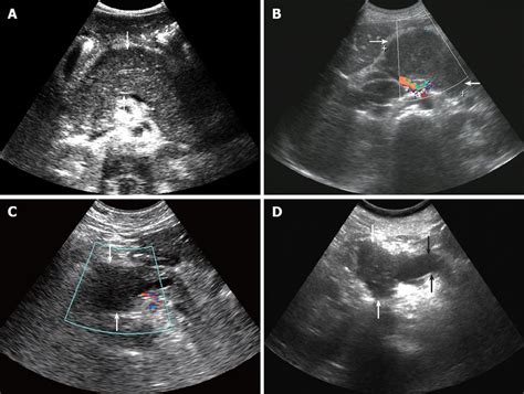 Pancreatic Adenocarcinoma Ultrasound