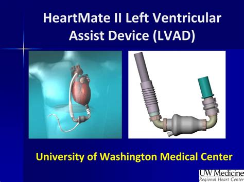 Lvad Heartmate Ii