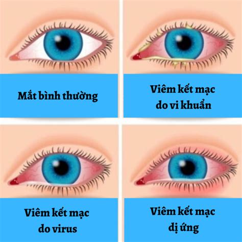 VIÊM KẾT MẠC - VIÊM KẾT MẠC DO VIRUS. - Bệnh viện Mắt Việt Nhật