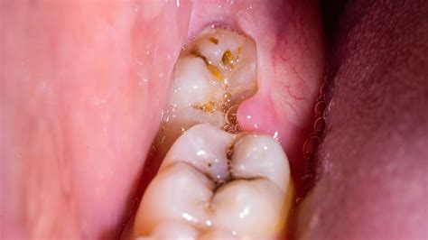 Pericoronaritis Inflamaci N En La Enc A Que Rodea La Muela Del Juicio